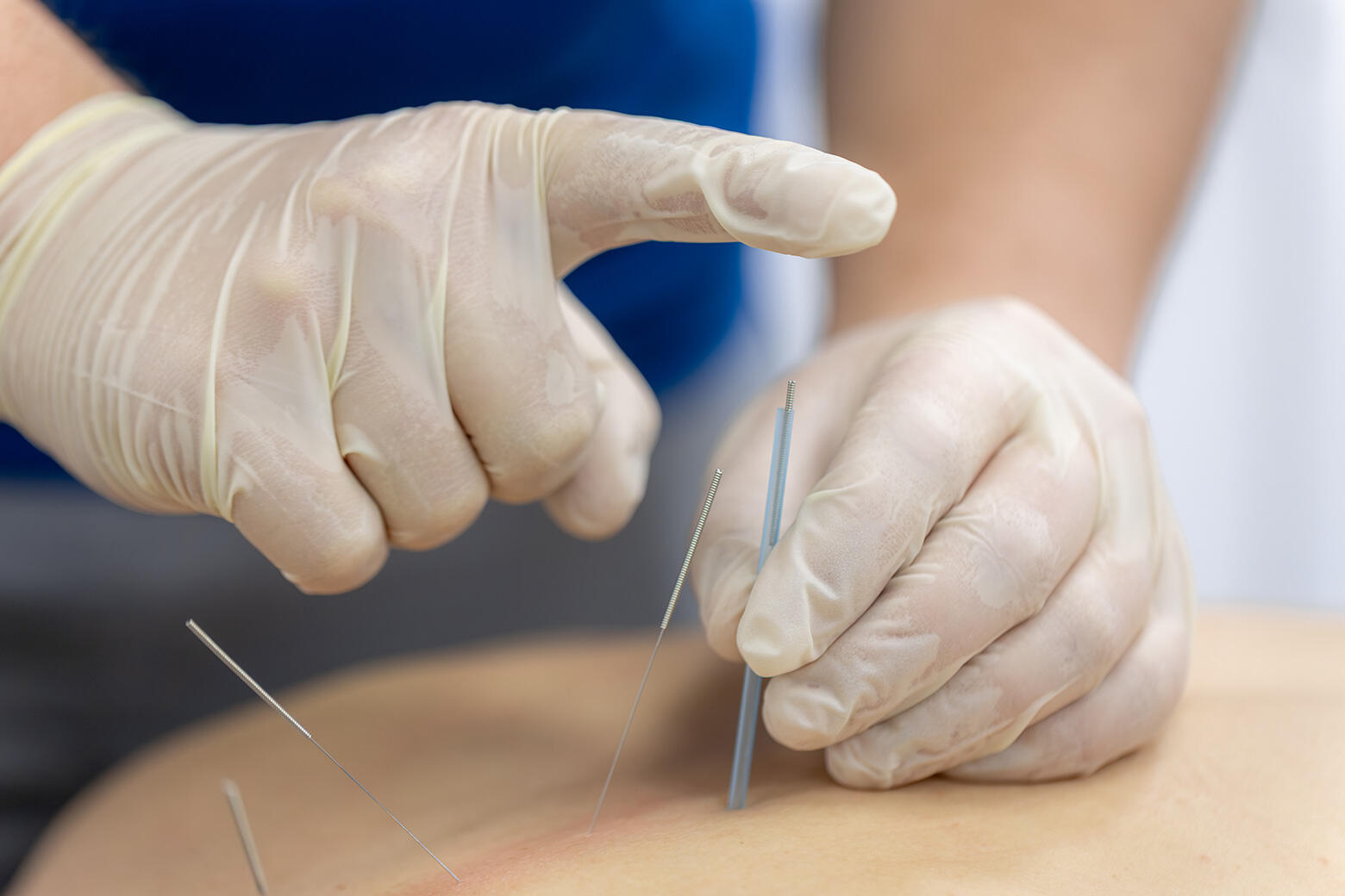 Integrating Acupuncture in Radiation Therapy and Survivorship.