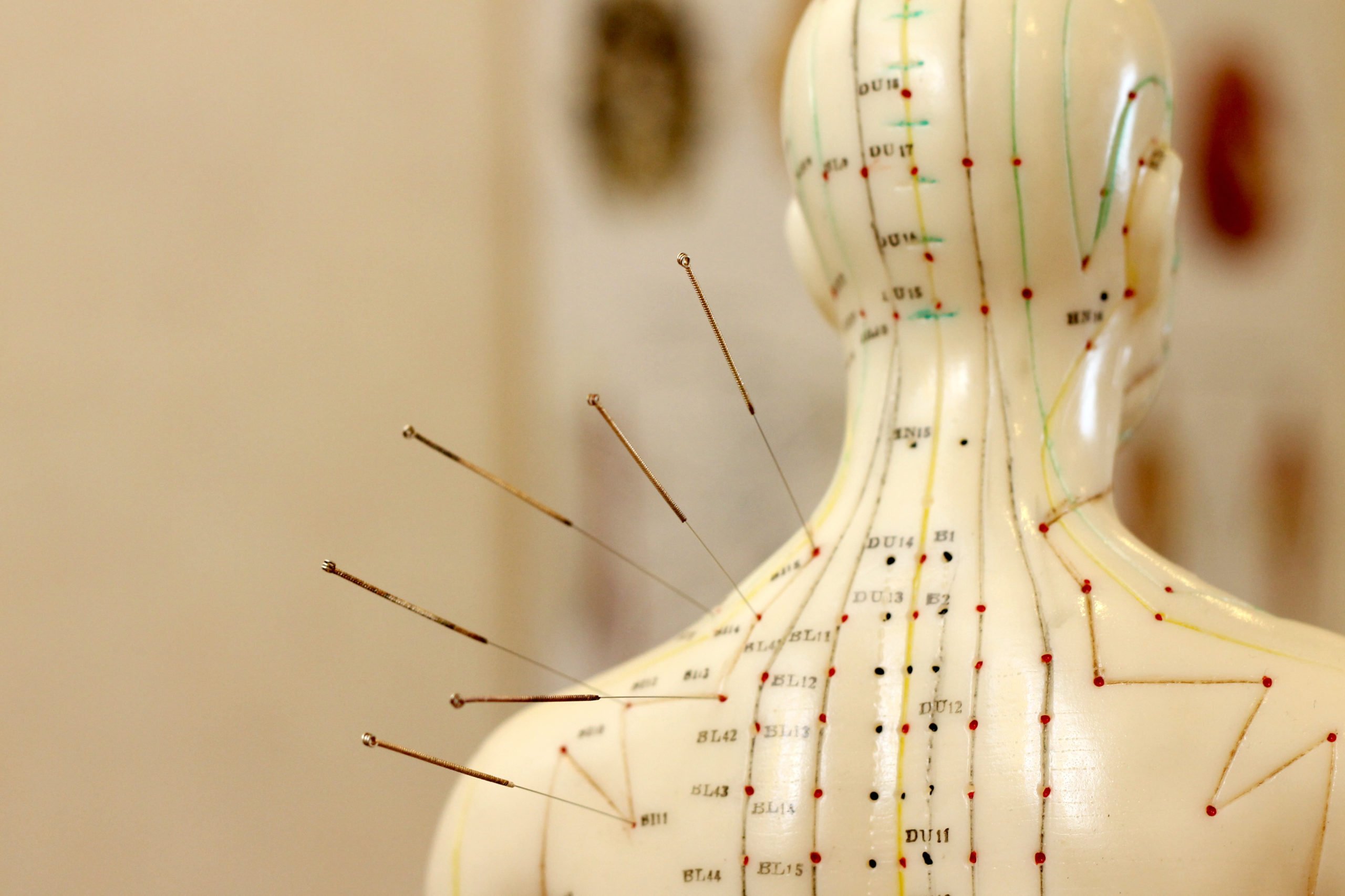Acupuncture versus Sham Acupuncture for Migraine without Aura: A Systematic Review and Meta-Analysis.