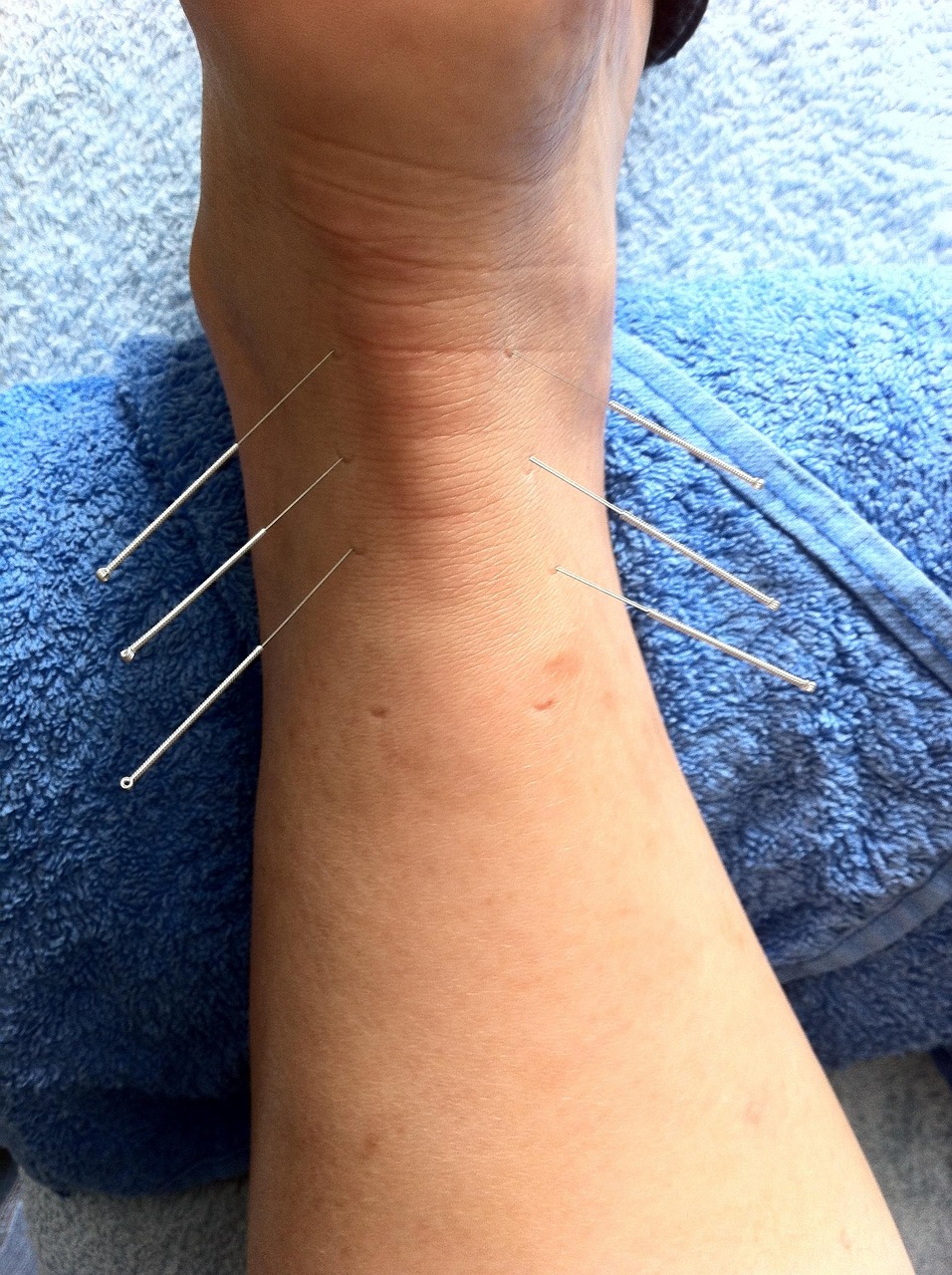 Electroacupuncture attenuates synovitis in knee osteoarthritis and is associated with modulation of the protein S-TAM (Axl/MerTK)-Rac1 signaling axis.