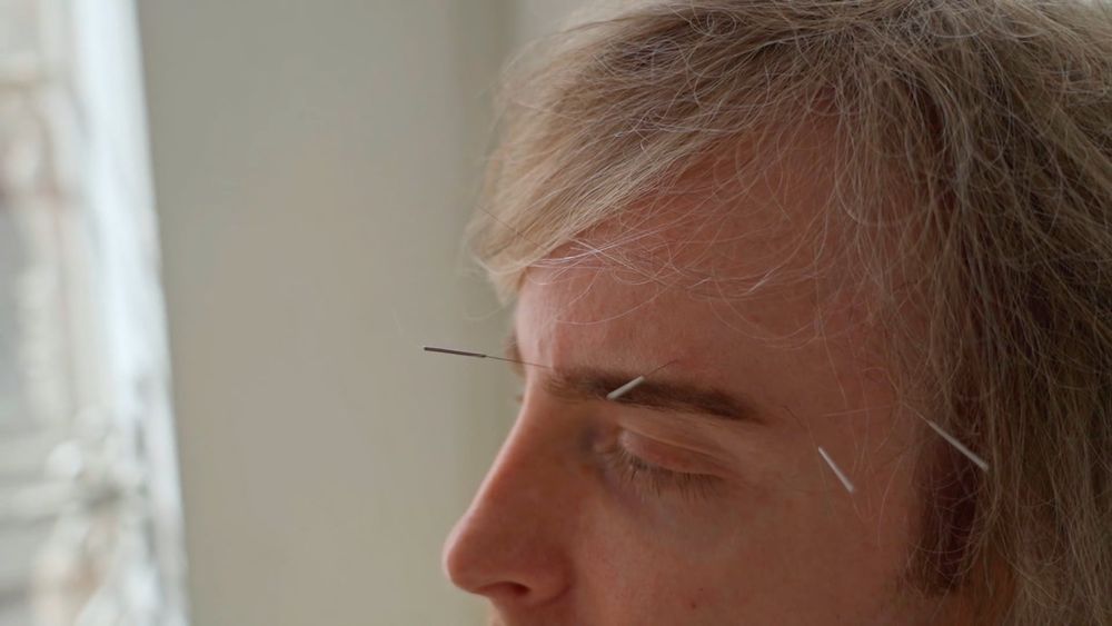 EEG microstate responses of migraine patients to transcutaneous electrical nerve stimulation.