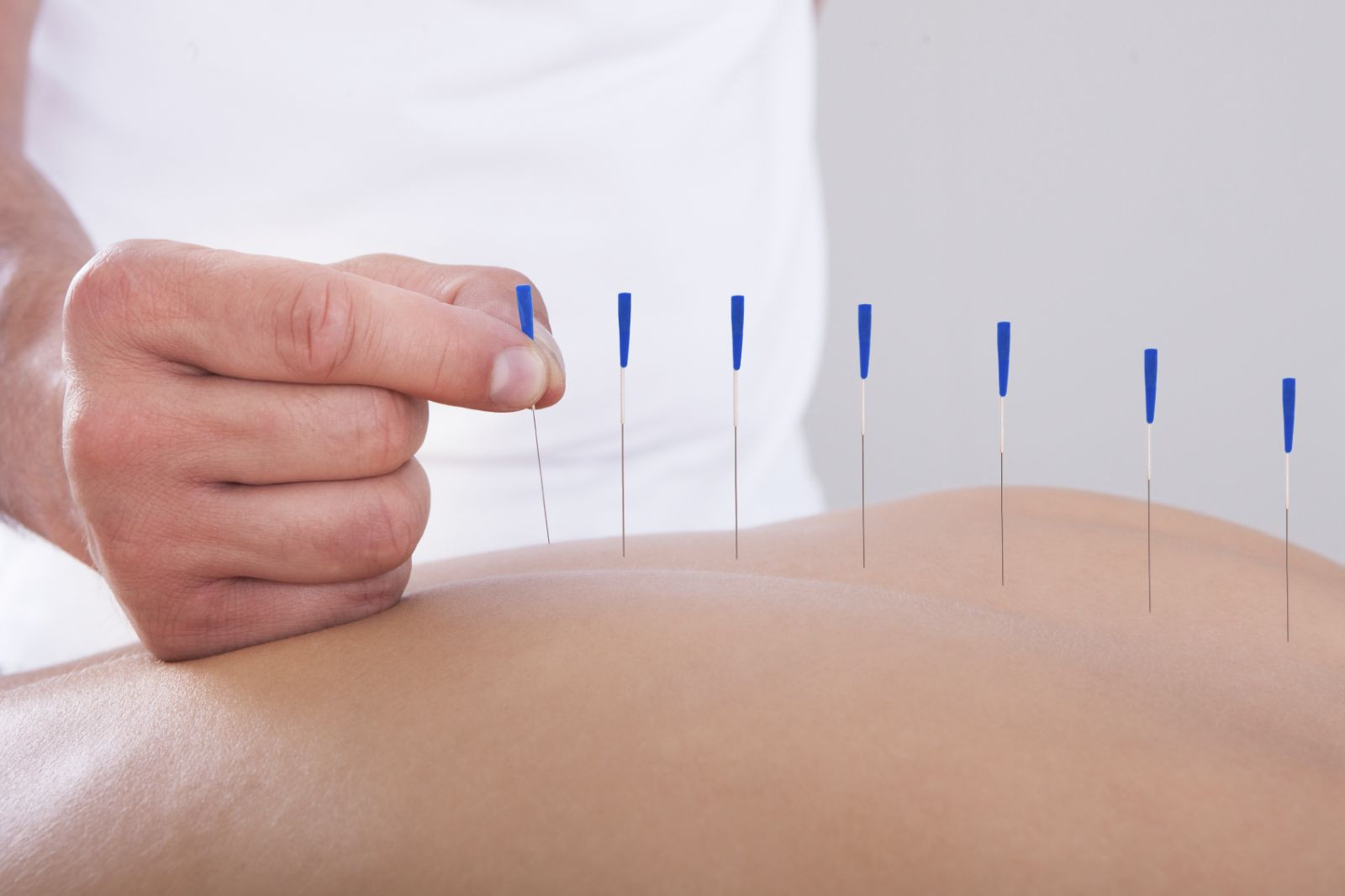 Effects of Preemptive Analgesia Using Wrist-Ankle Acupuncture on Postoperative Pain and Urinary Retention After Haemorrhoidectomy: A Randomised, Three-Arm, Clinical Trial.