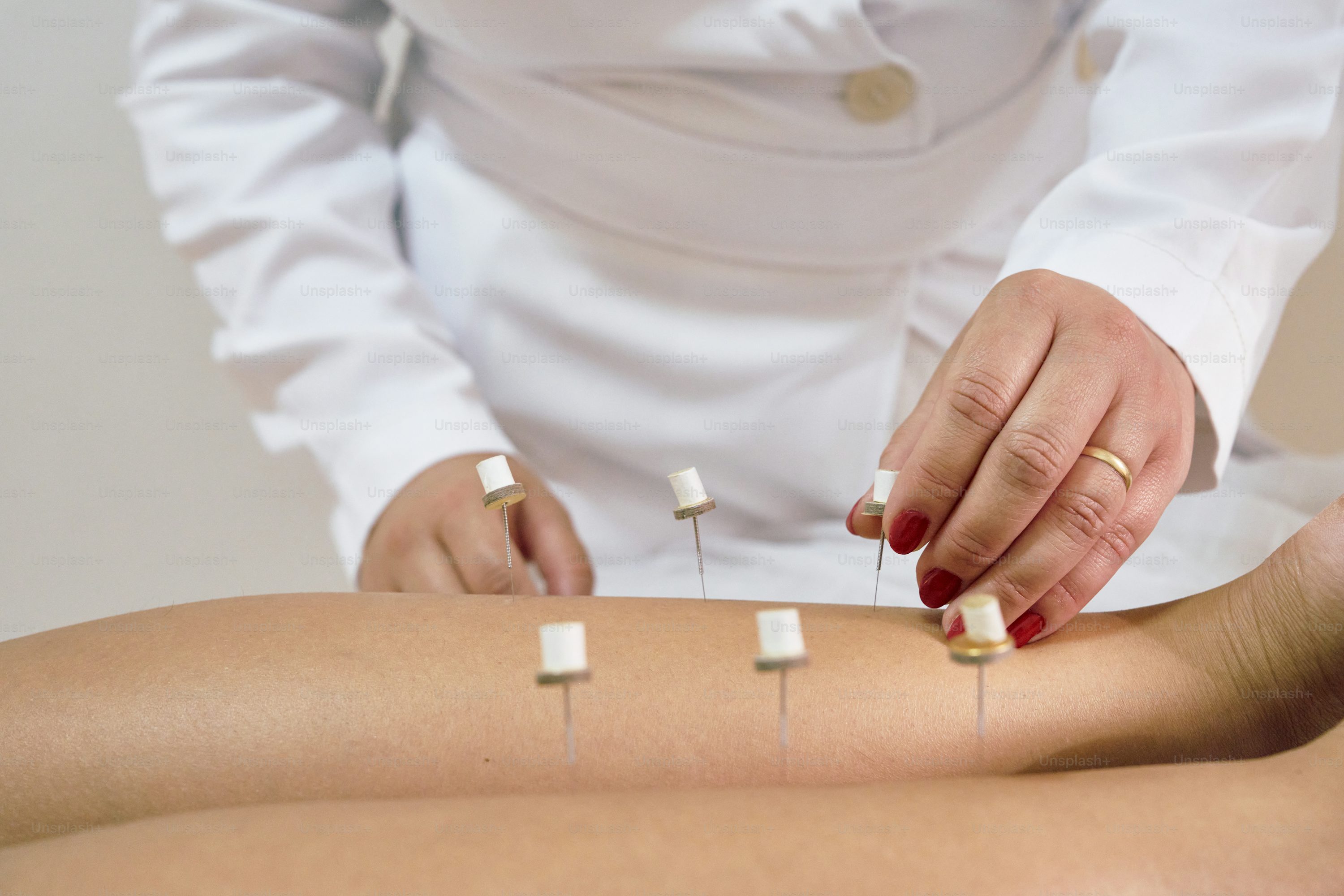 Effects of Acupuncture on Arterial Hypertension and Endothelial Dysfunction: The AHEaD Trial.