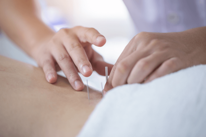 Dry needling combined with percutaneous electrical stimulation using a needle-surface configuration for musculoskeletal pain: A systematic review.