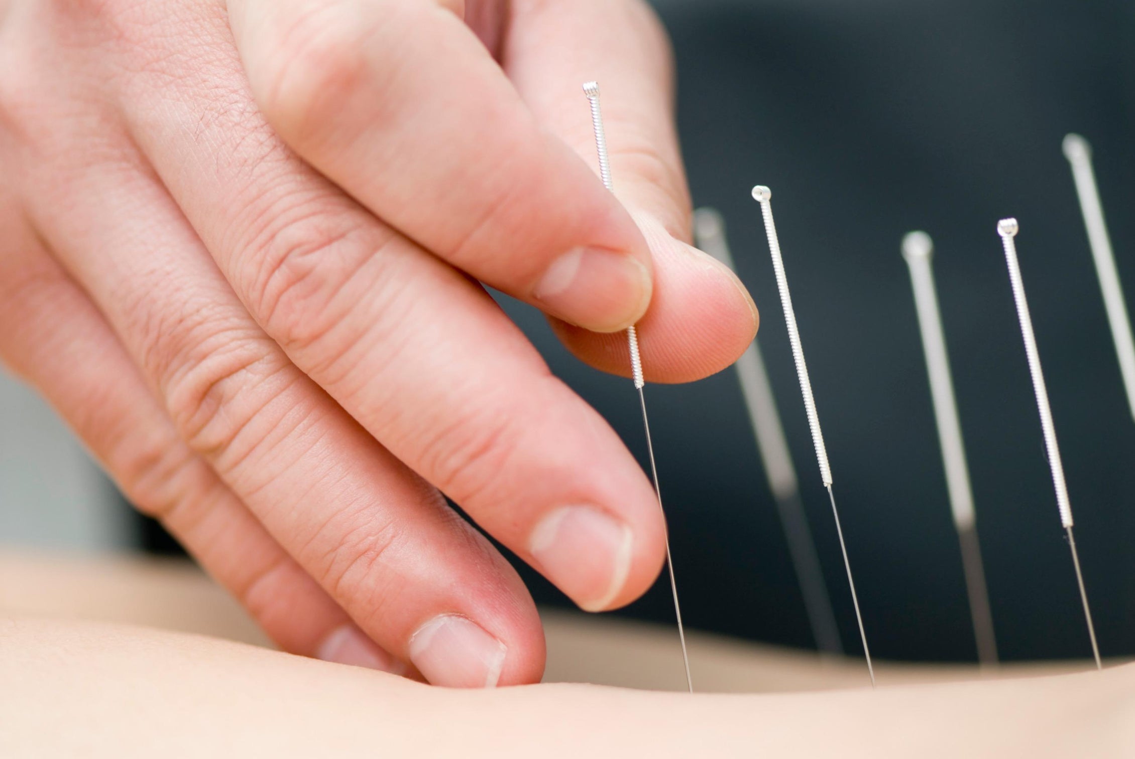 Warm-Needling Acupuncture Plus Tuina for Knee Osteoarthritis: Considerations Regarding Effect Estimates, Comparator Design, and Assay Standardization [Letter].