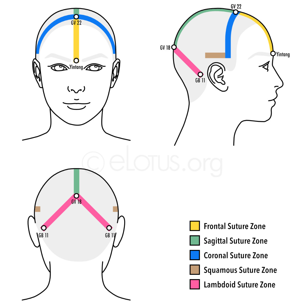 Пять зон Tai's Scalp Acupuncture по швам черепа